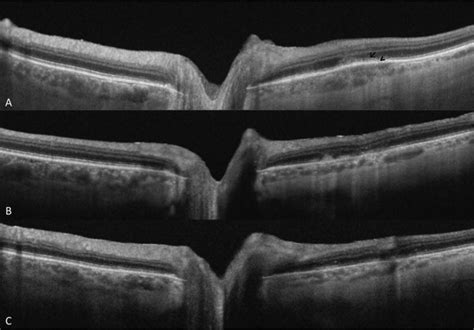 Swept Source Optical Coherence Tomography Ss Oct Images Orientated As