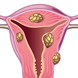 Mejores Ginecologos Para Miomas Uterinos Doctor Especialistas