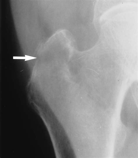 Lesser Trochanter Avulsion Fracture