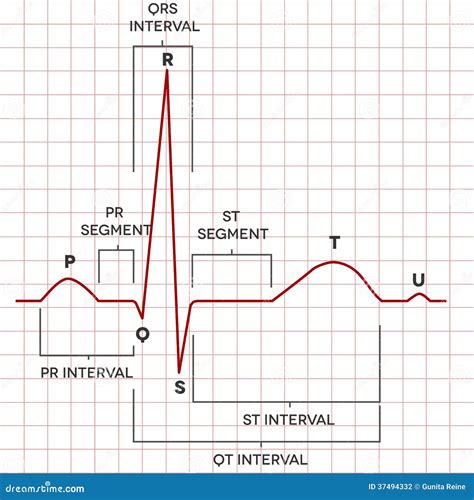 ECG Of A Heart In Normal Sinus Rhythm Cartoon Vector | CartoonDealer ...