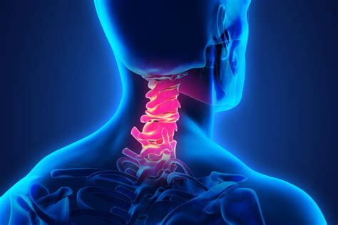 Average Settlement Amounts For Cervical Herniation And Cervical Fusion