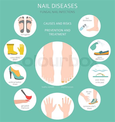 Nail diseases. Onychomycosis, nail fungal infection causes, treatment