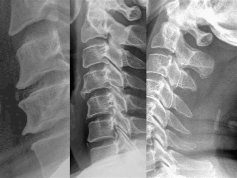 An Analysis Of Heterotopic Ossification In Cervical Disc Arthroplasty A Novel Morphologic