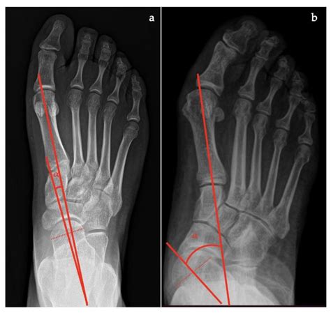 Diagnostics Free Full Text Adult Acquired Flatfoot Deformity A