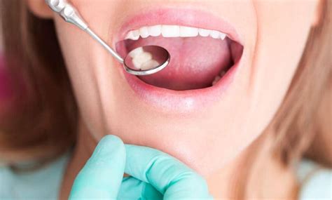 Tooth Discoloration 4 Best Ways To Prevent And Treat It