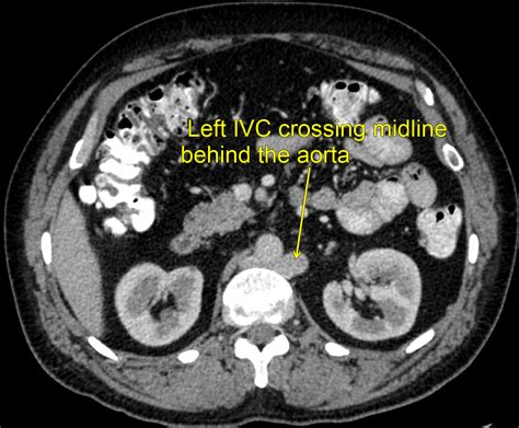 Left Sided Ivc With Azygos Continuation And Retroaortic Right Renal