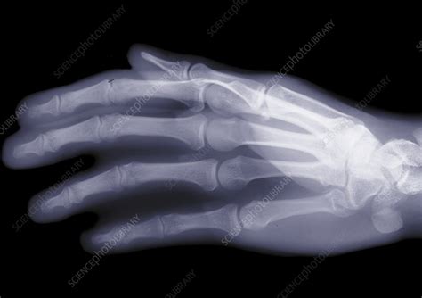 Human hand, X-ray - Stock Image - F029/8255 - Science Photo Library