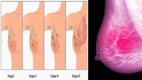 Naked Women In The Age Of Cancer Photos