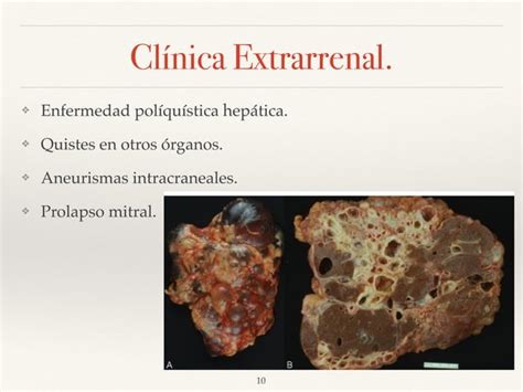 Poliquistosis Renal Ppt