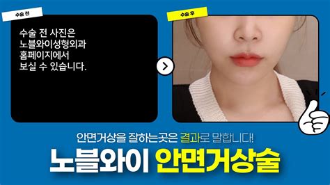 얼굴처짐 리프팅 안면거상후기 사진으로 효과 확인해보세요 ★더보기란 필독★ Youtube