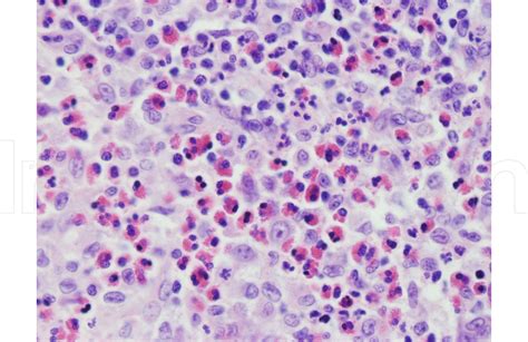 Figure 7 From Skin Biopsy Diagnosis Of Langerhans Cell Neoplasms