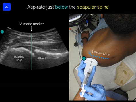 Arthrocentesis: Shoulder — Highland EM Ultrasound Fueled pain management