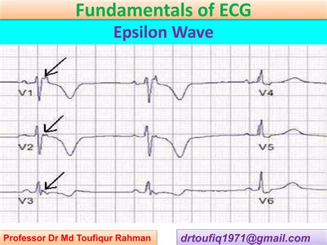 epsilon wave  ecg ppsx