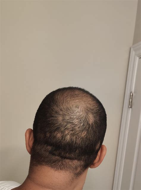 3 Months Progress With Finasteride 0 5mg Daily Minoxidil Foam5 2x