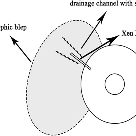 Cross Section View Of The Drainage Implants Left To Right Xen