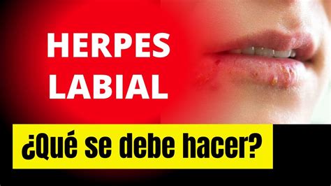 Herpes Labial Qu Se Debe Hacer Youtube