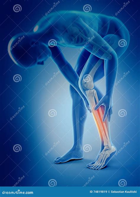 Calf Pain Explanation With Cramp From Muscle Contraction Outline