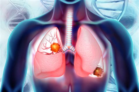 Assessing Characteristics And Prognosis Of Synchronous Multiple Primary