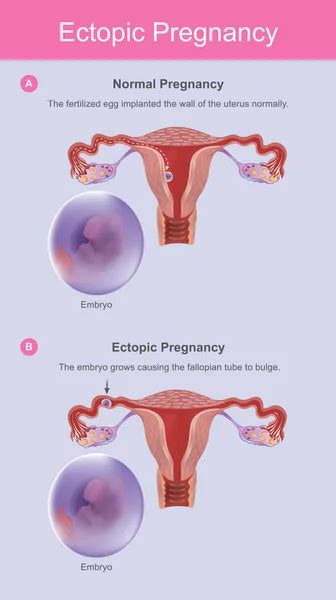 Ectopic Pregnancy Vector Images Depositphotos