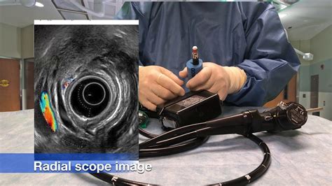 Radial Endoscopic Ultrasound Scope Primer YouTube