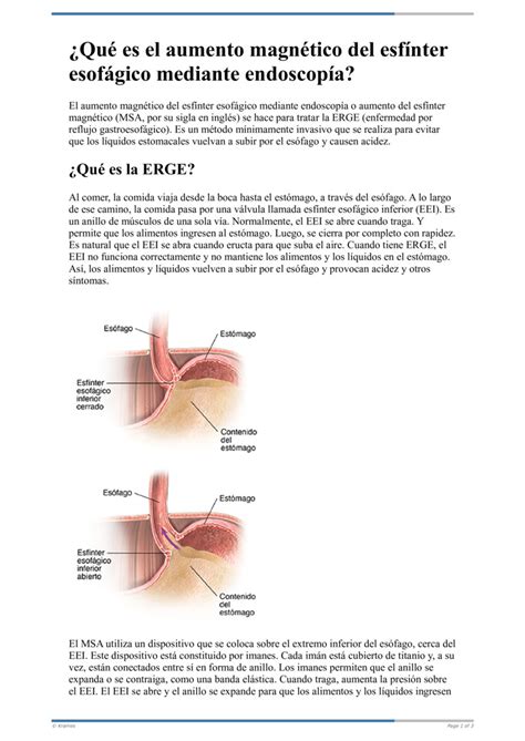 Text Qué es el aumento magnético del esfínter esofágico mediante