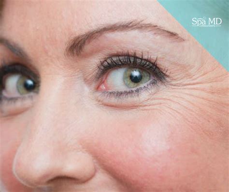 Getting Rid Of Crows Feet With Botox Spa MD