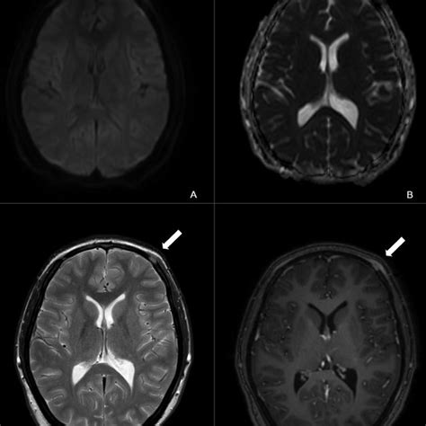 Axial Dwiadc Map Ab T2 Spin Echo C And 3d Gadolinium Enhanced