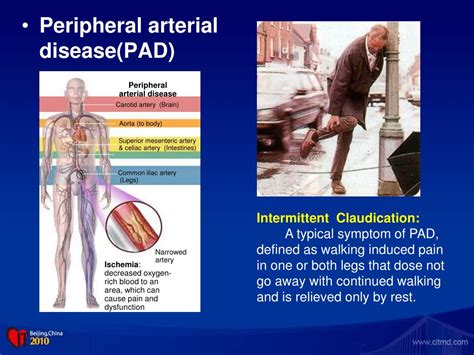 Ppt Exercise Therapy For Intermittent Claudication Powerpoint Presentation Id 4803259