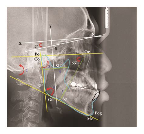 Cephalometric Landmarks Linear And Angular Measurements N Nasion S