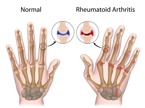 Arthritis