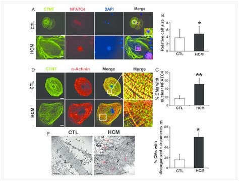 Phenotypic Characterization Of Hcm Ipsc Cms A Representative