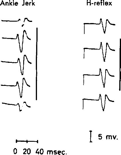 Figure 1 From The Jendrassik Maneuver Semantic Scholar