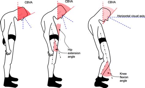 Clinical Analysis Of Global And Cervical Deformity Using The Chin Brow