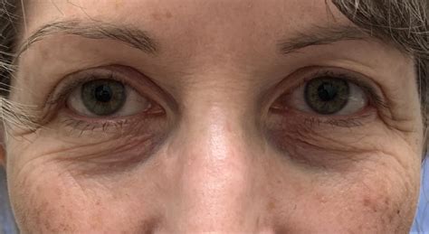 33 Eyelid Surgery Before And After Photos Dallas Plano Texas Cosmetic Reconstructive Eye Surgery