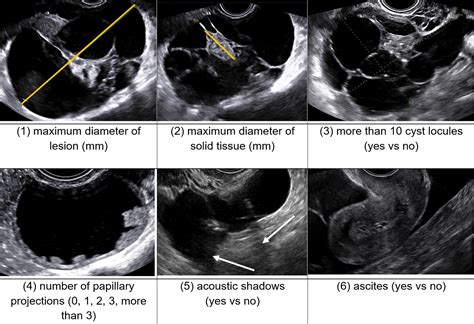 O Rads Us Risk Stratification And Management System A Consensus Guideline From The Acr Ovarian