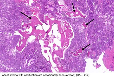 Pathology Outlines Typical Carcinoid Tumor Neuroendocrine Tumor