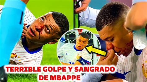 El Terrible Golpe De Mbappe En Su Nariz Adi S A La Eurocopa Youtube