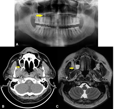 Oral Malignant Melanoma A Rarity Bmj Case Reports