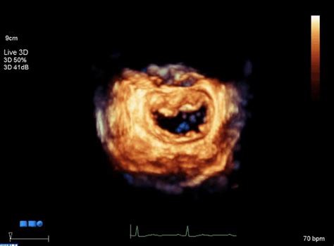 3d Echocardiography In Congenital Heart Disease Dr Els Van Laeken Shda