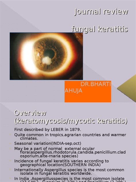 Fungal Keratitis Contact Lens Ophthalmology