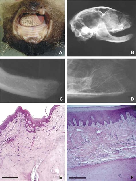 Figure From Congenital Oligodontia Of The Deciduous Teeth And