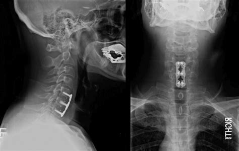 Cervical Fusion Or Acdf Mr J Peters Willke