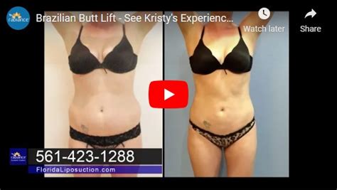 Smart Lipo In Boca Raton Laser Assisted Liposuction Minimally Invasive