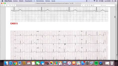 Como Calcular Frecuencia Cardiaca En Ekg Youtube