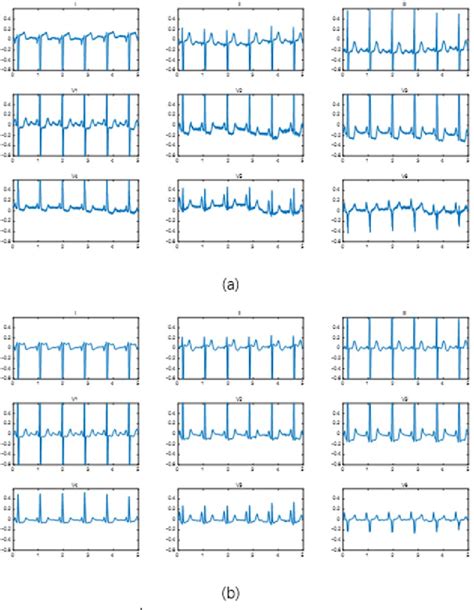 Figure From Electrocardiographic Criteria For The Diagnosis Of Left