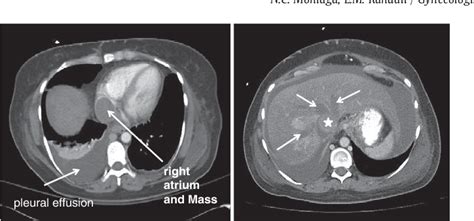 Figure From Uterine Leiomyomatosis With Intracaval And Intracardiac