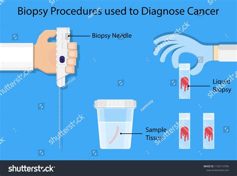 163 Needle Biopsy Sample Images, Stock Photos, and Vectors | Shutterstock