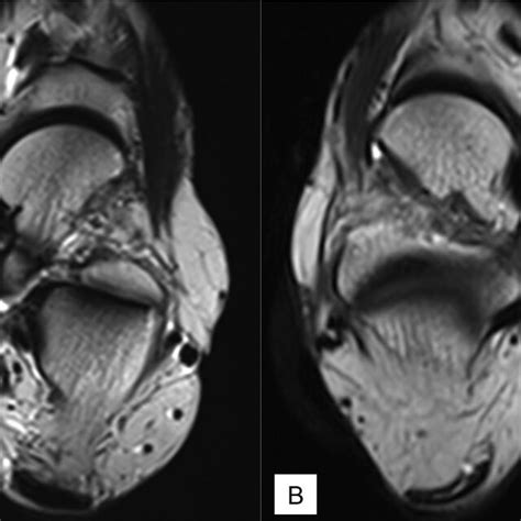 Tendinosis Axial T2 Weighted Tse Mr Image At The Level Of The Left