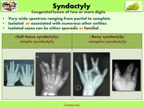 Easy Radiology Congenital Bone Diseases And Malformation And Normal