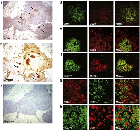 In Vivo Distribution Of Bdnf And P Ntr In Hyperplastic Thymus